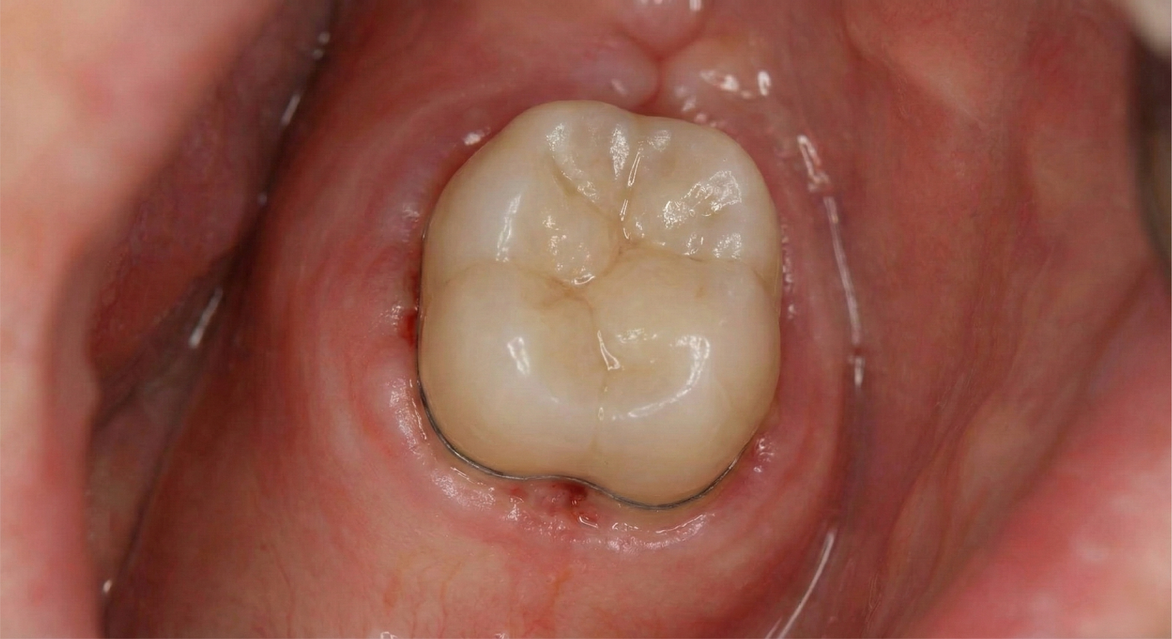 After — PFM Crowns